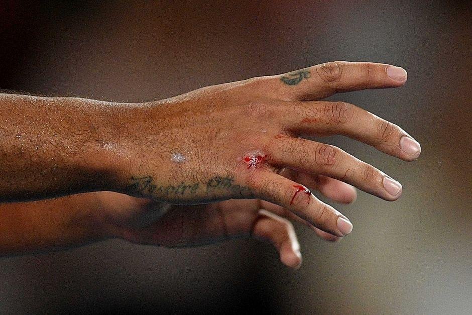 Blood on Nick Kyrgios' hand